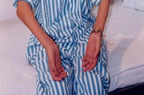 虽然导致先天性肌肉萎缩的病因有很多,包括由全身营养障碍,废用,内